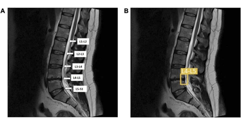 Disk prolapse mri